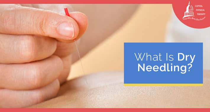 What Is Dry Needling? | Capitol Physical Therapy Washington DC | Pain & Injury Management