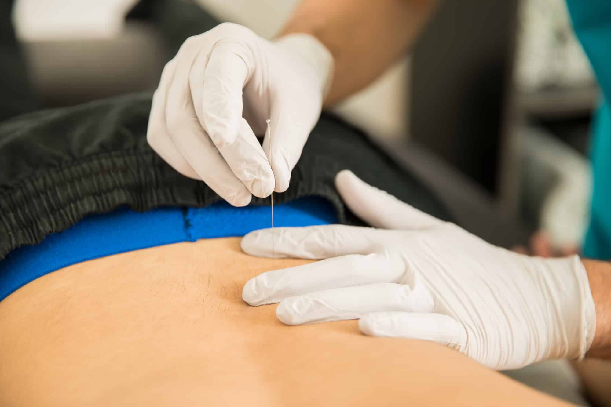 Using dry needling in physiotherapy — Pelvico Health Centre