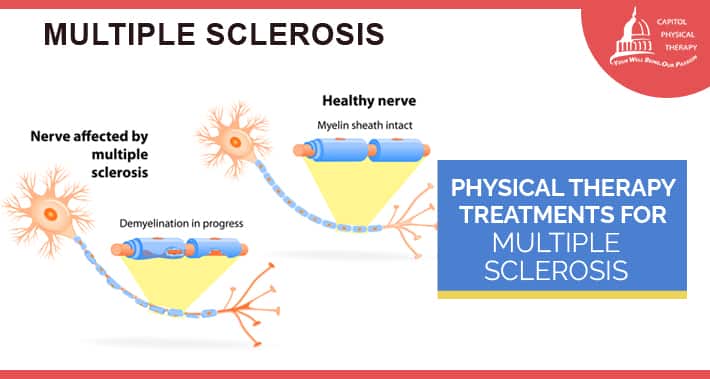 Physical Therapy For Multiple Sclerosis | Washington DC Physical Therapists