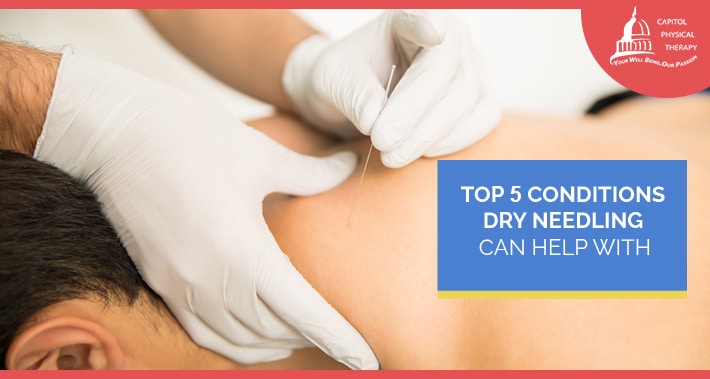 Top 5 Conditions Dry Needling Can Help With | Capitol Physical Therapy | Washington DC Physical Therapists