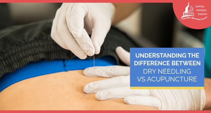 Understanding The Difference Between Dry Needling Vs Acupuncture | Capitol Physical Therapy | Washington DC Physical Therapists