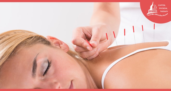 benefits of dry needling versus acupuncture | Capitol Physical Therapy | Washington DC Physical Therapists