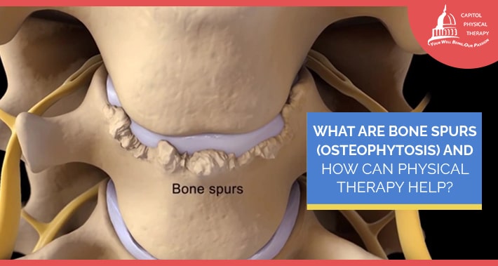 What Are Bone Spurs (Osteophytosis) And How Can Physical Therapy Help? | Capitol Physical Therapy | Washington DC Physical Therapists