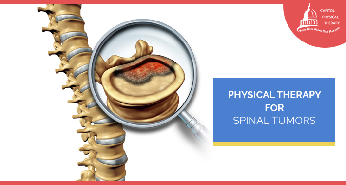Physical Therapy For Recovery After Spinal Tumor Surgery | Capitol Physical Therapy | Washington DC Physical Therapists