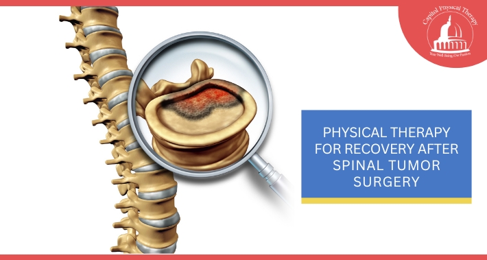 Physical Therapy For Recovery After Spinal Tumor Surgery | Capitol Physical Therapy | Washington DC Physical Therapists