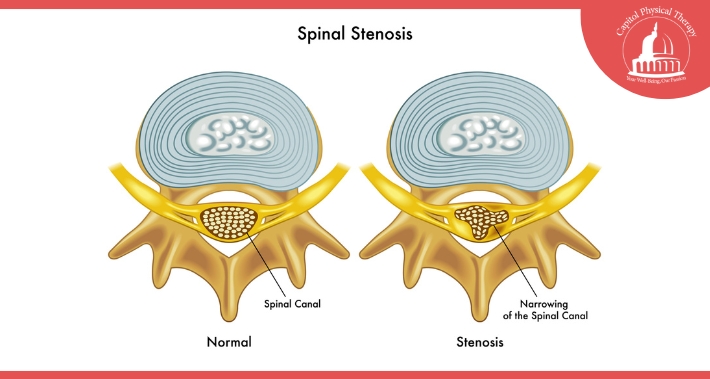 What Is Spinal Stenosis? | Capitol Physical Therapy | Washington DC Physical Therapists