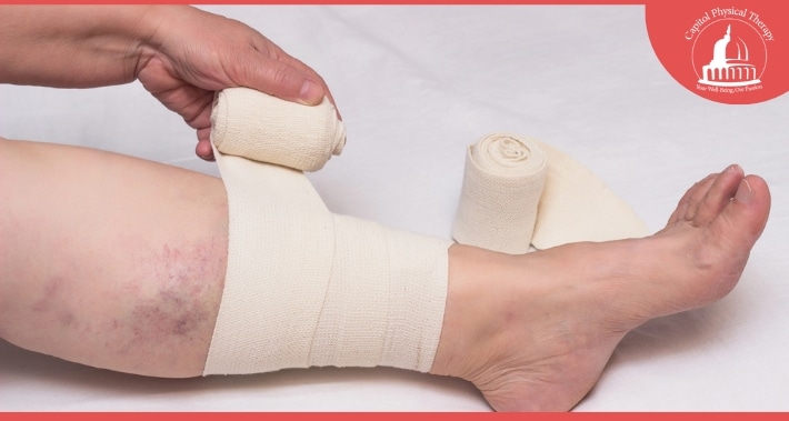 How Physical Therapy Can Help Treat Varicose Veins - Using A Compression Bandage | Capitol Physical Therapy | Washington DC Physical Therapists