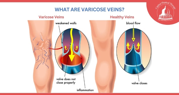 What Are Varicose Veins? | Capitol Physical Therapy | Washington DC Physical Therapists