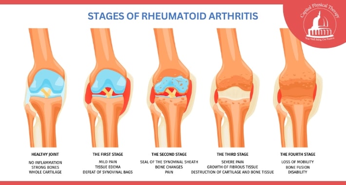 Stages of Rheumatoid Arthritis Diagram | Capitol Physical Therapy | Washington DC Physical Therapists