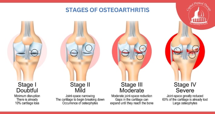 Stages of Osteoarthritis Diagram | Capitol Physical Therapy | Washington DC Physical Therapists