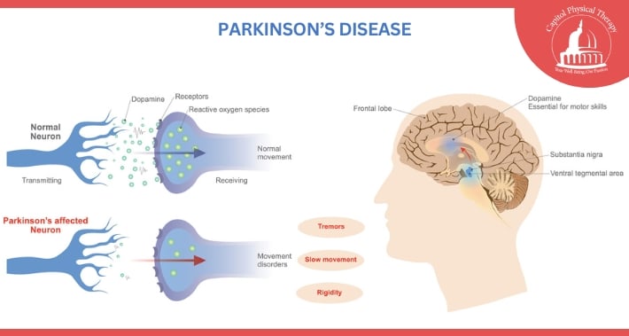 Parkinson’s Disease Diagram | Capitol Physical Therapy | Washington DC Physical Therapists