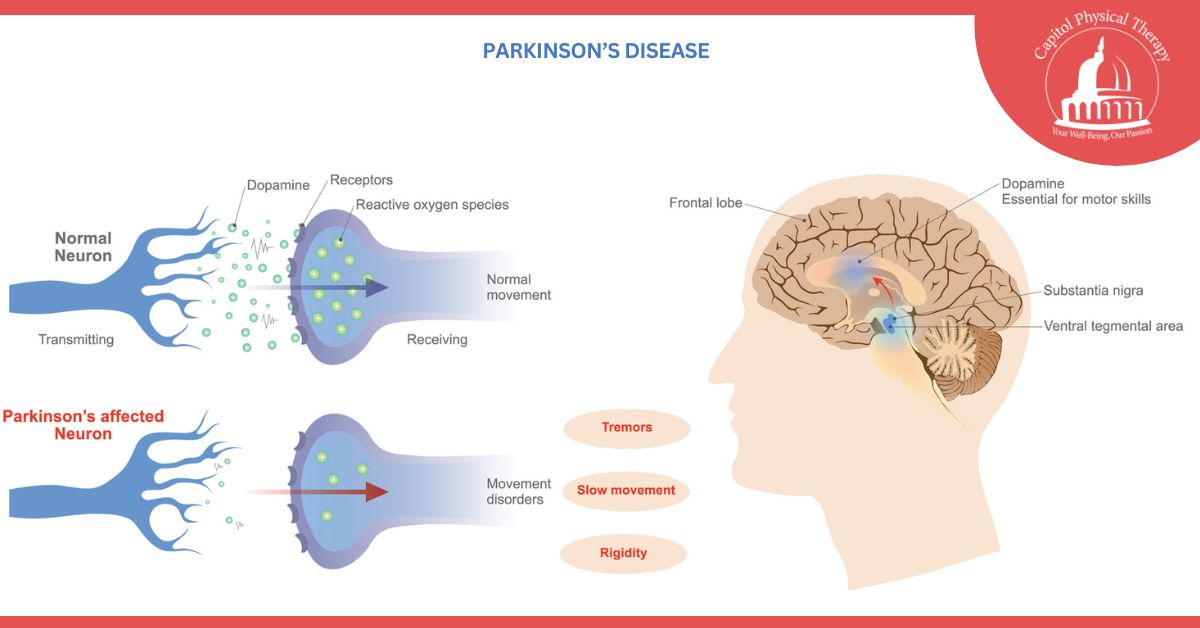 Parkinson’s Disease | Capitol Physical Therapy | Washington DC Physical Therapists