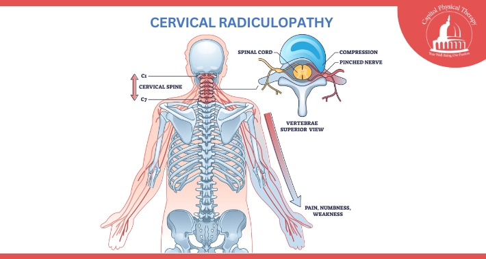 Diagram of Cervical Radiculopathy | Capitol Physical Therapy | Washington DC Physical Therapists