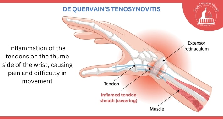 Diagram of De Quervain’s Tenosynovitis | Capitol Physical Therapy | Washington DC Physical Therapists
