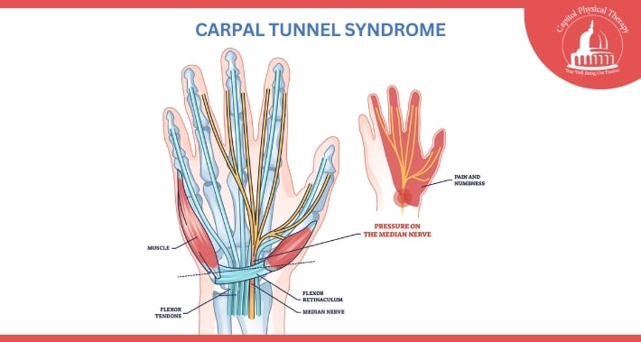 Diagram of Carpal Tunnel Syndrome | Capitol Physical Therapy | Washington DC Physical Therapists